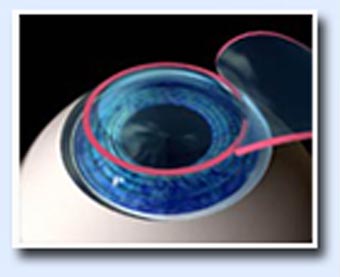 Lasik surgery